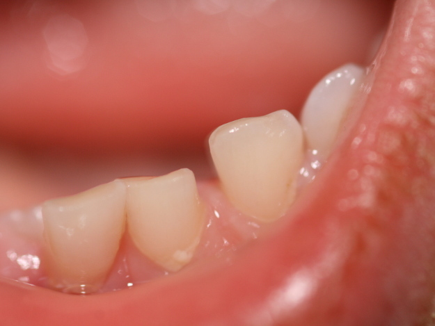 Zahnverfärbungen vorbeugen